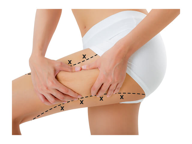 RSL sculpting & endospheres therapy